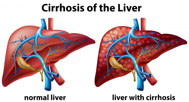 The Top 10 Deadliest Diseases In The World Cirrhosis