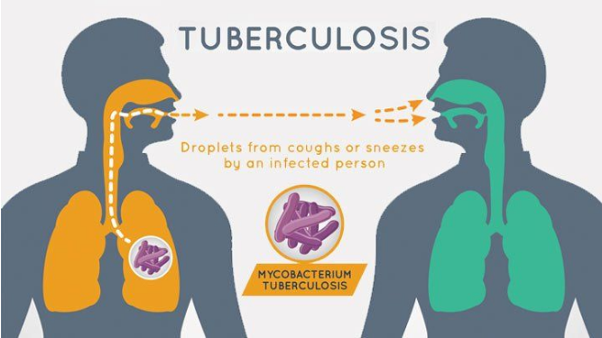 The Top 10 Deadliest Diseases In The World Tuberculosis